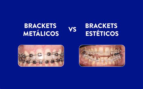 brackets transparentes vs metalicos|Brackets transparentes .